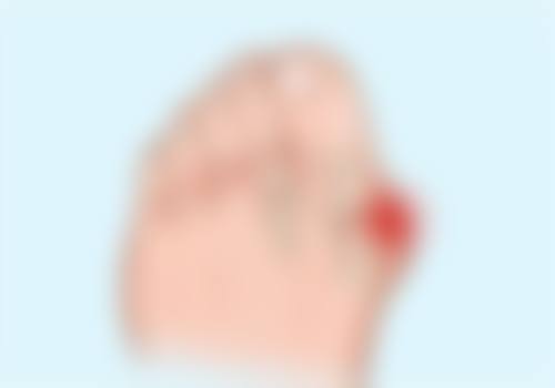 激光洗眉后留下疤痕怎么办？了解留疤原因与处理办法让你告别烦恼