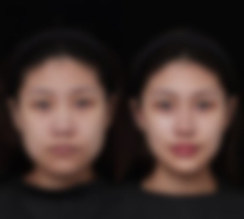 脸部疤痕可以美容吗？女性脸部疤痕通过美容手术改善效果因人而异！ 