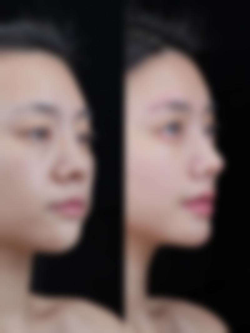 一、怎么样消除黑眼圈和眼袋之一般治疗