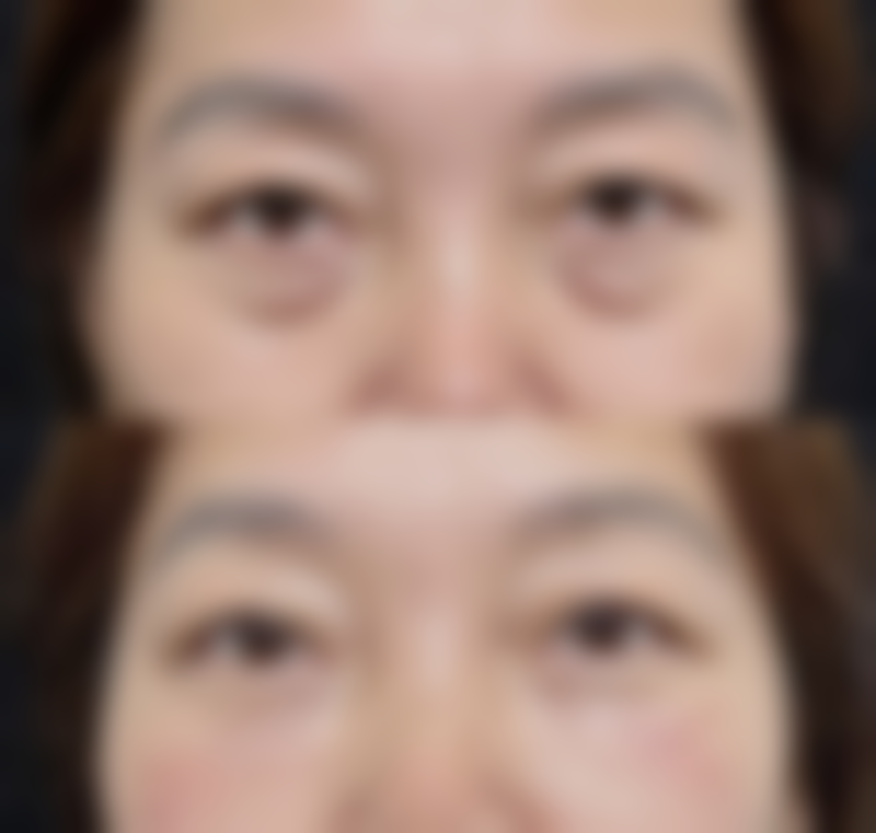 七、脸部疤痕可以美容吗？总结与展望