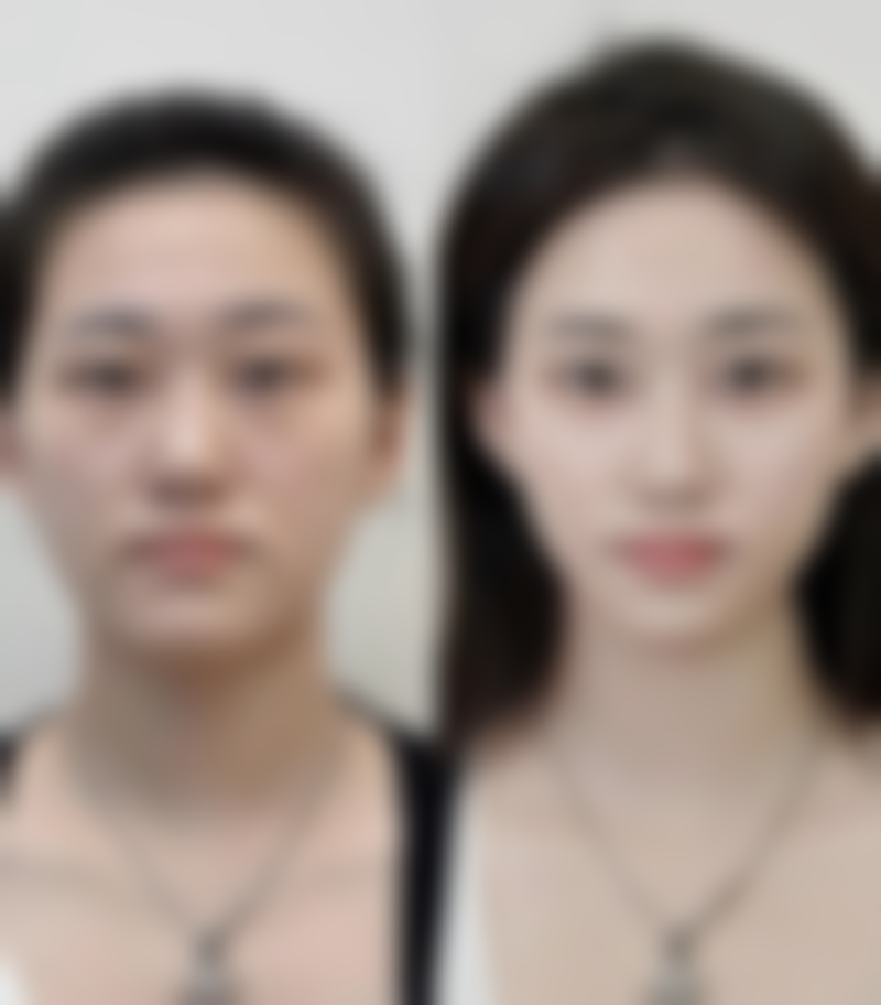 宝宝有凸起来的疤痕怎么办？多种改善方法及对应图片展示助你解决难题 