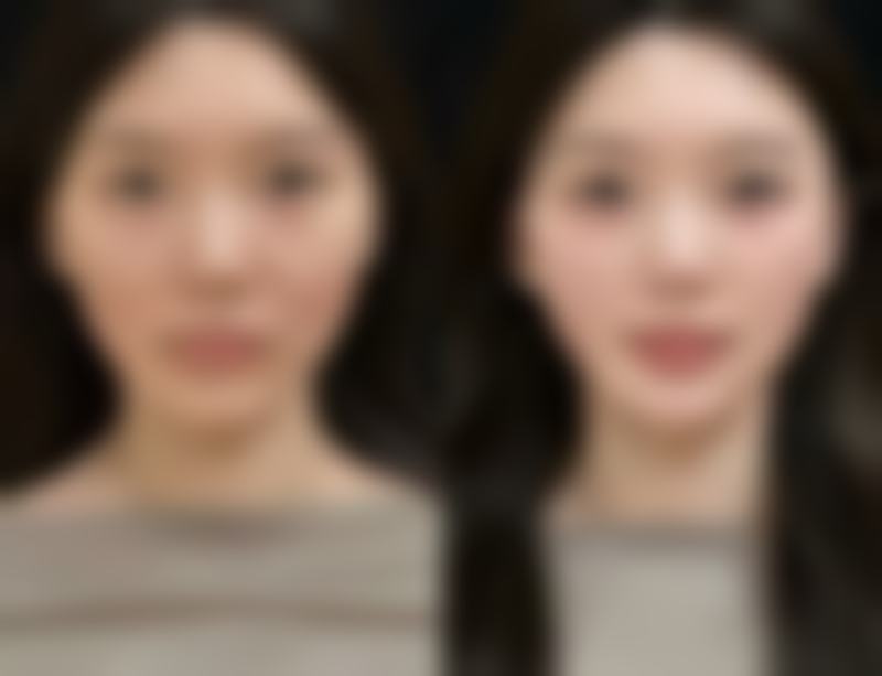 如果有眼袋的话应该要怎么消除它？物理、手术、日常护理方法大揭秘