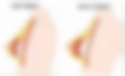 三、注射隆胸后可以喂母乳吗？注射材料对母乳的影响