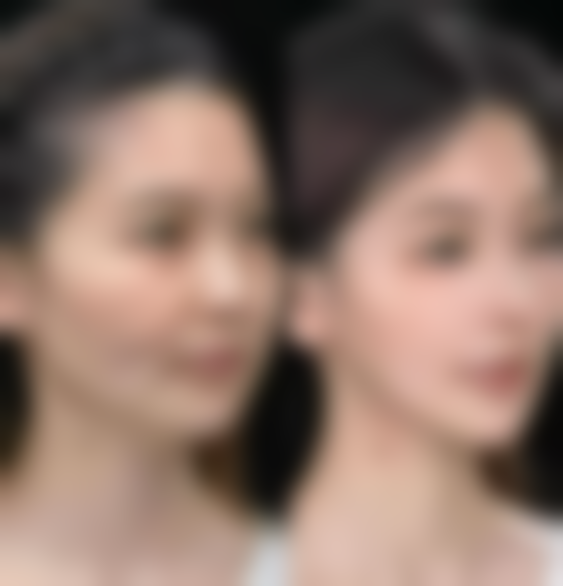 二、注射隆胸后可以喂母乳吗？理论上的情况