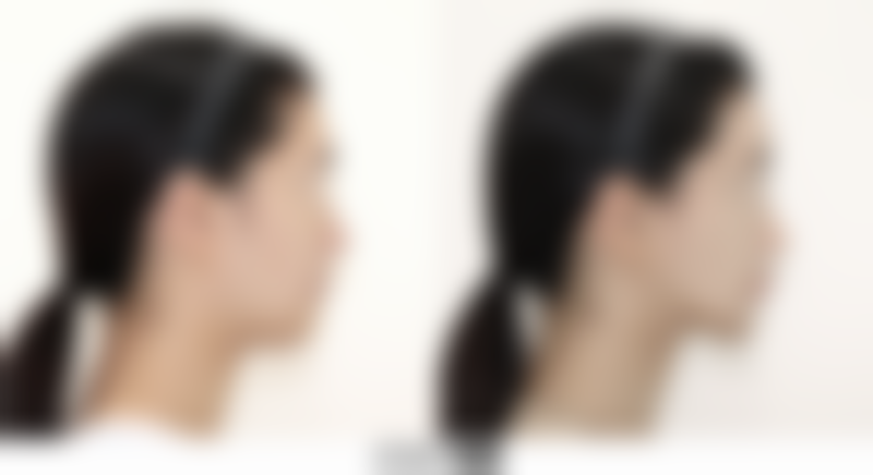 二、烧伤后的疤痕能治好吗？红色疤痕消失时间大揭秘