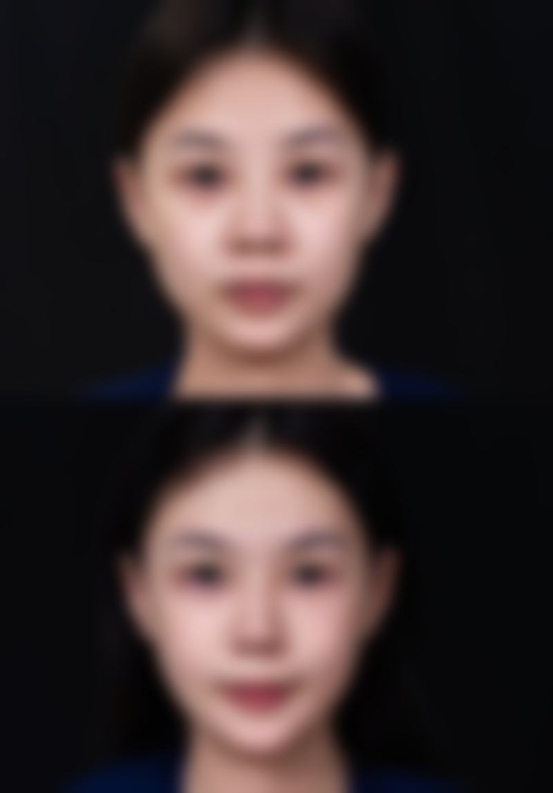 四、不同部位疤痕增生切除修复的差异