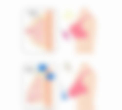 二、眼睑外伤造成一岁的宝宝双眼皮变单眼皮