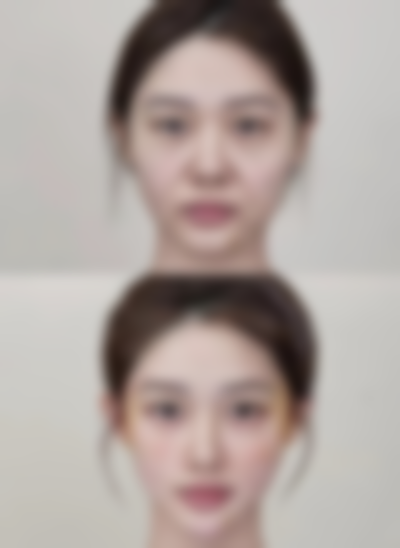 二、看眼袋要挂什么科之美容考虑因素