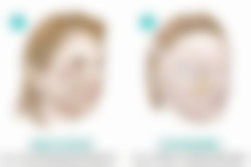 一、打3次瘦脸针能维持多久呢？先了解基本情况