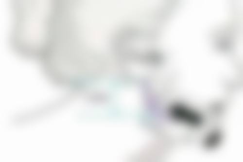 五、眼袋大是怎么会事？遗传因素也不容忽视