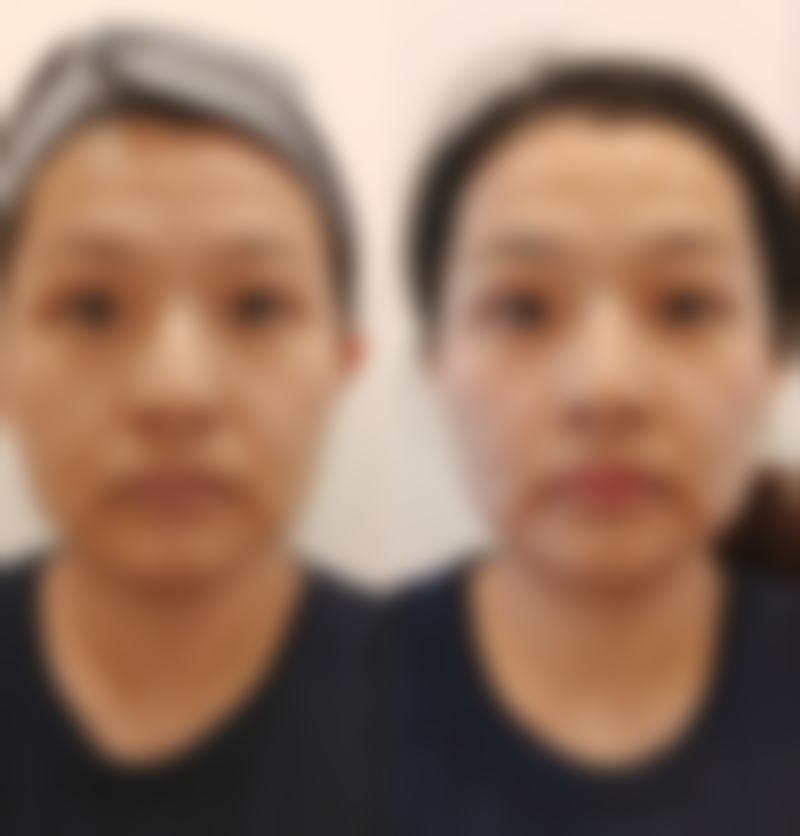 五、怎么消除眼袋成效好之日常护理