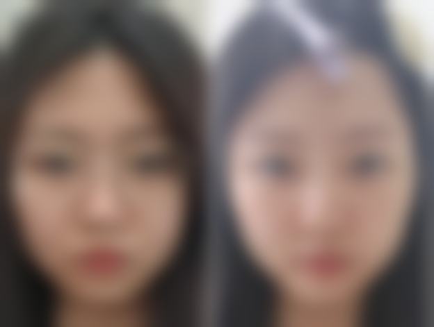 四、去了眼袋后下眼皮还是松的注意事项