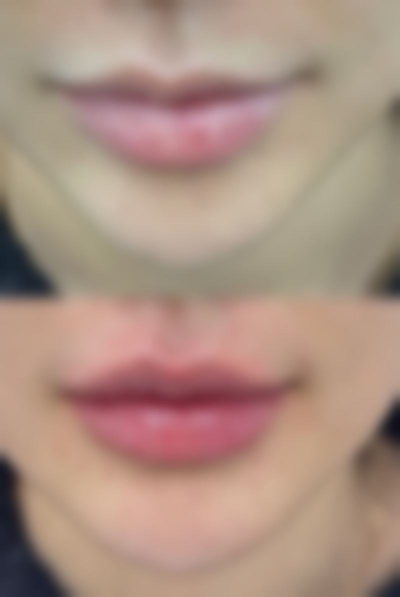 三、怎么消除眼袋成效好之射频治疗