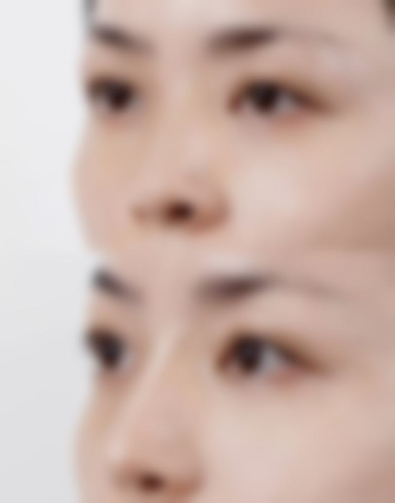 怎么消除眼袋效果好？手术、激光、射频等方法及日常护理全攻略来了！ 