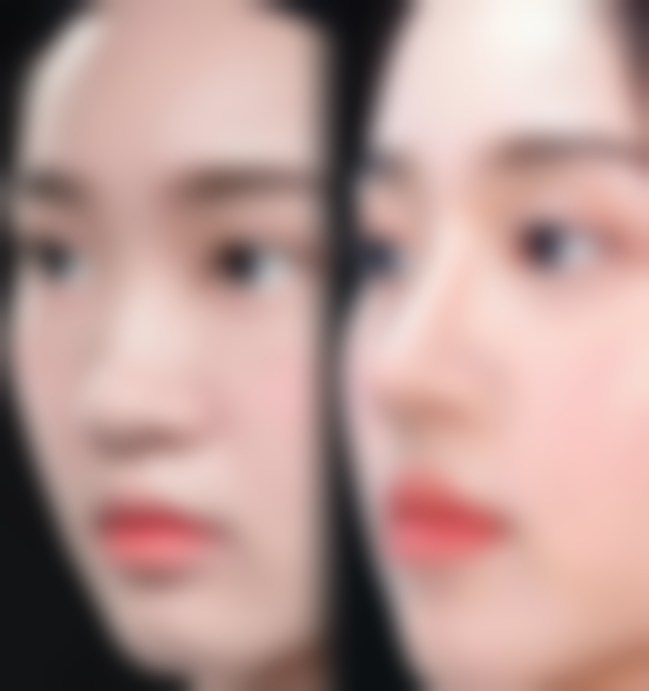 二、全切双眼皮提肌大小眼的诊断方法