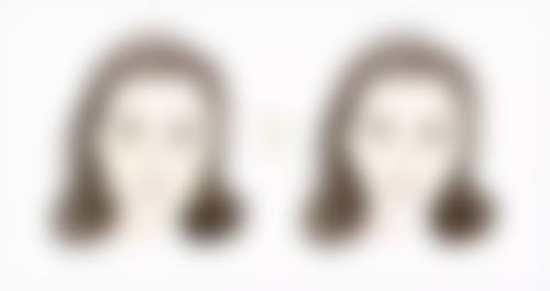 一、认识凹陷疤痕