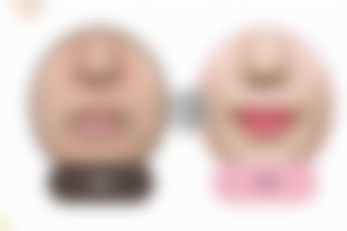 二、影响现在的技术割双眼皮风险的因素