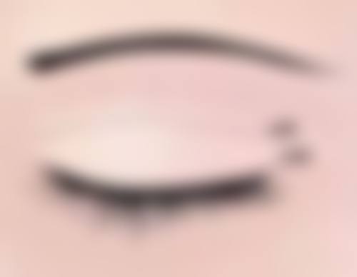 四、手术治疗胸口的疤痕疙瘩