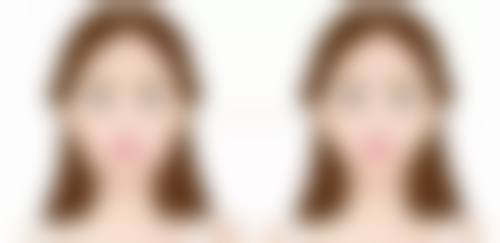 假体隆胸后遗症有吗？