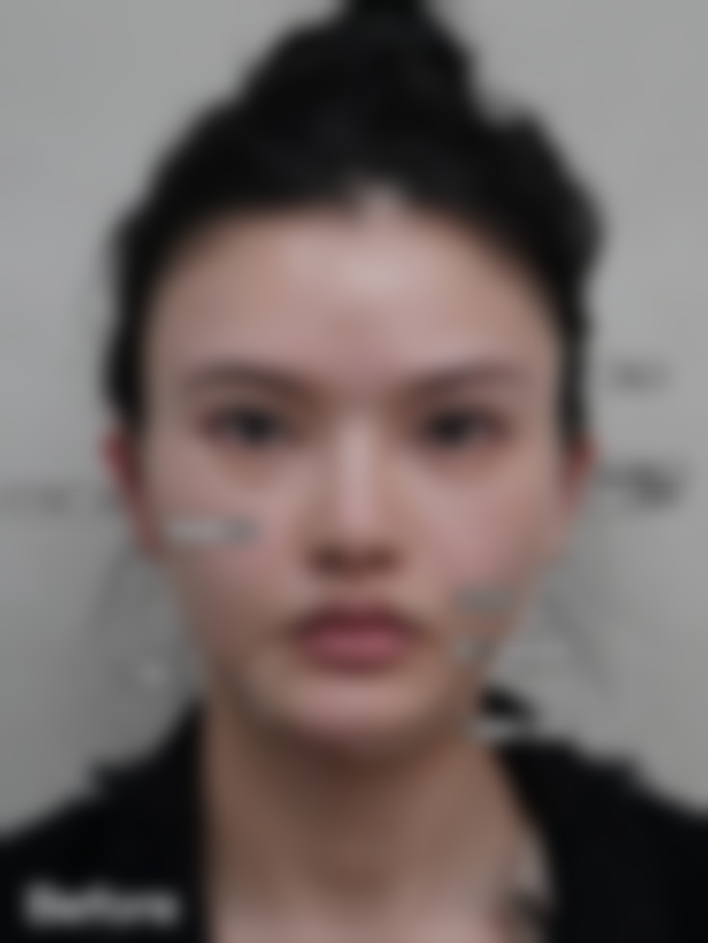 三、西安艺星医疗美容医院霍菲医生擅长项目之超声炮联合治疗