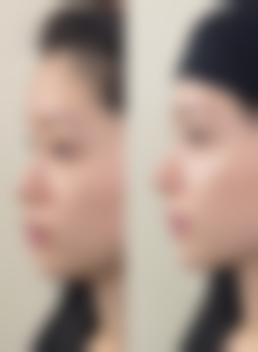 六、特殊人群现在的技术割双眼皮的风险