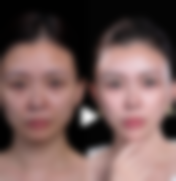 三、如何降低假体隆胸后遗症的风险