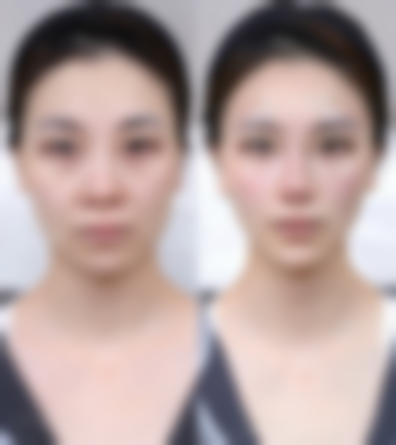 五、凹陷性疤痕相关图片参考