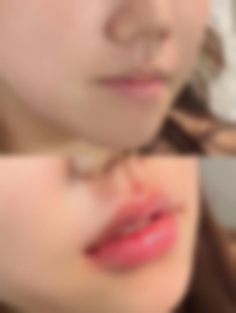 四、治疗凹陷性疤痕的注意事项