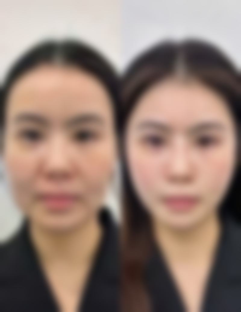 二、疤痕凹进去还能长平吗？答案是有可能