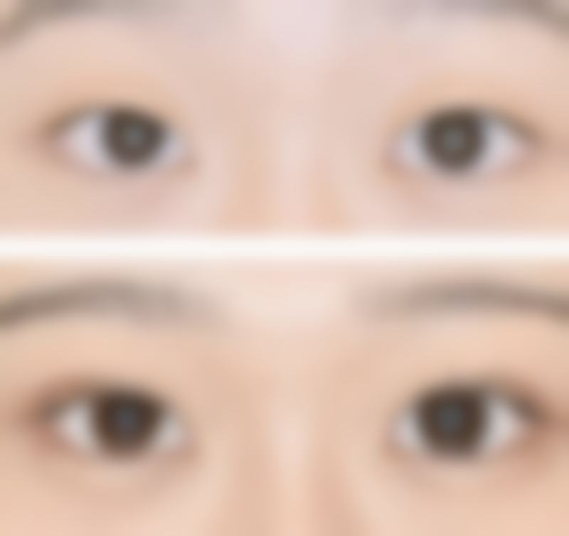 二、双眼皮手术的复杂性