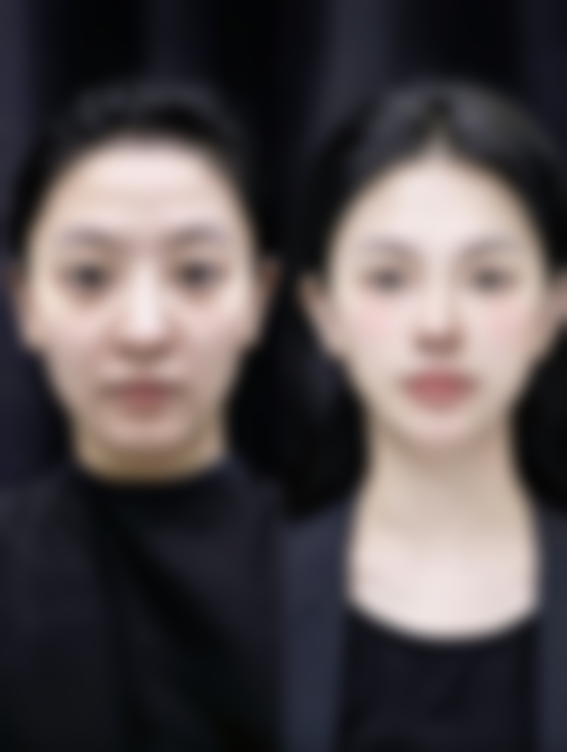 隆鼻二十天可以化妆吗？了解这些注意事项偶尔化妆一天或许可行！ 