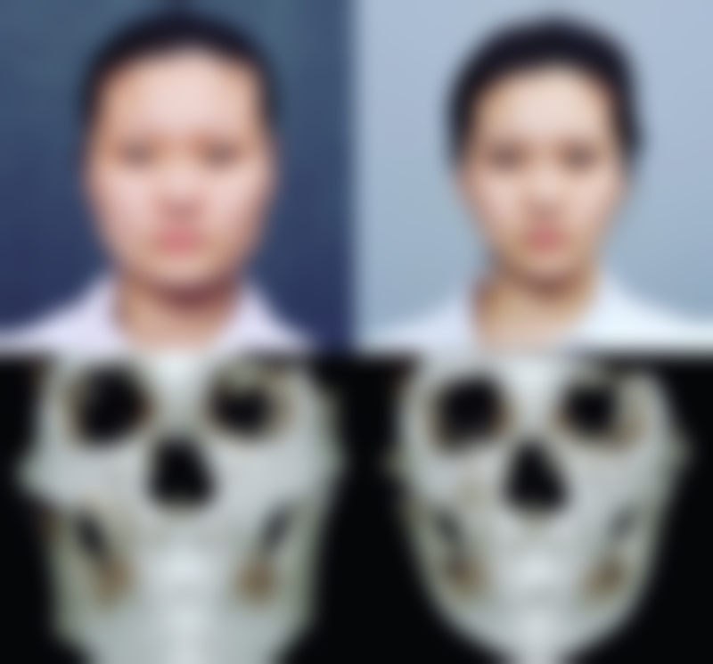 五、医美治疗黑眼圈眼袋