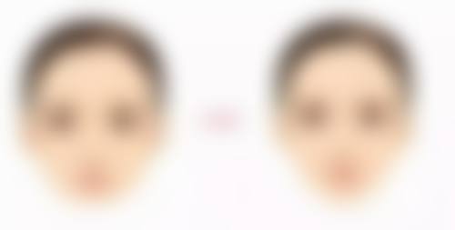 二、丰太阳穴用什么填充之自体脂肪填充