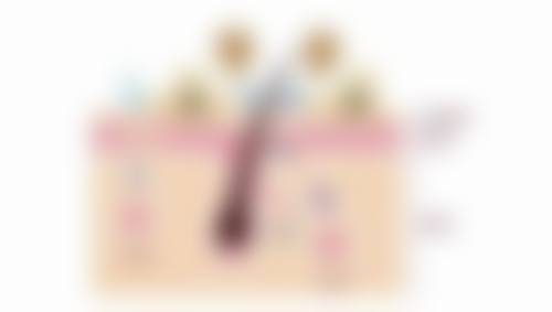 三、医学美容：应对顽固性色素疤痕