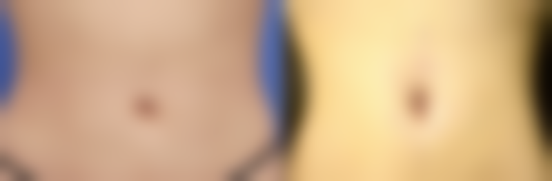 一、丰太阳穴用什么填充之玻尿酸填充