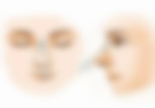 四、影响自体肋骨隆鼻持久性的因素