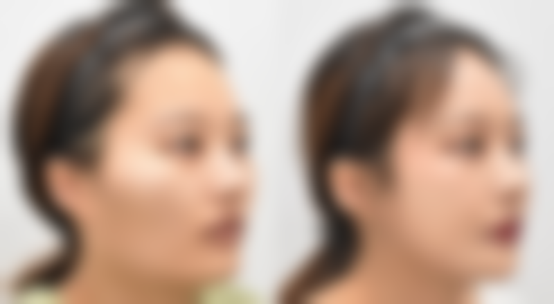 四、进口瘦脸针价格影响因素