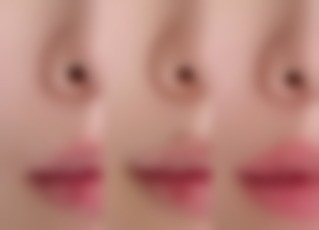 六、自体肋骨隆鼻的优缺点