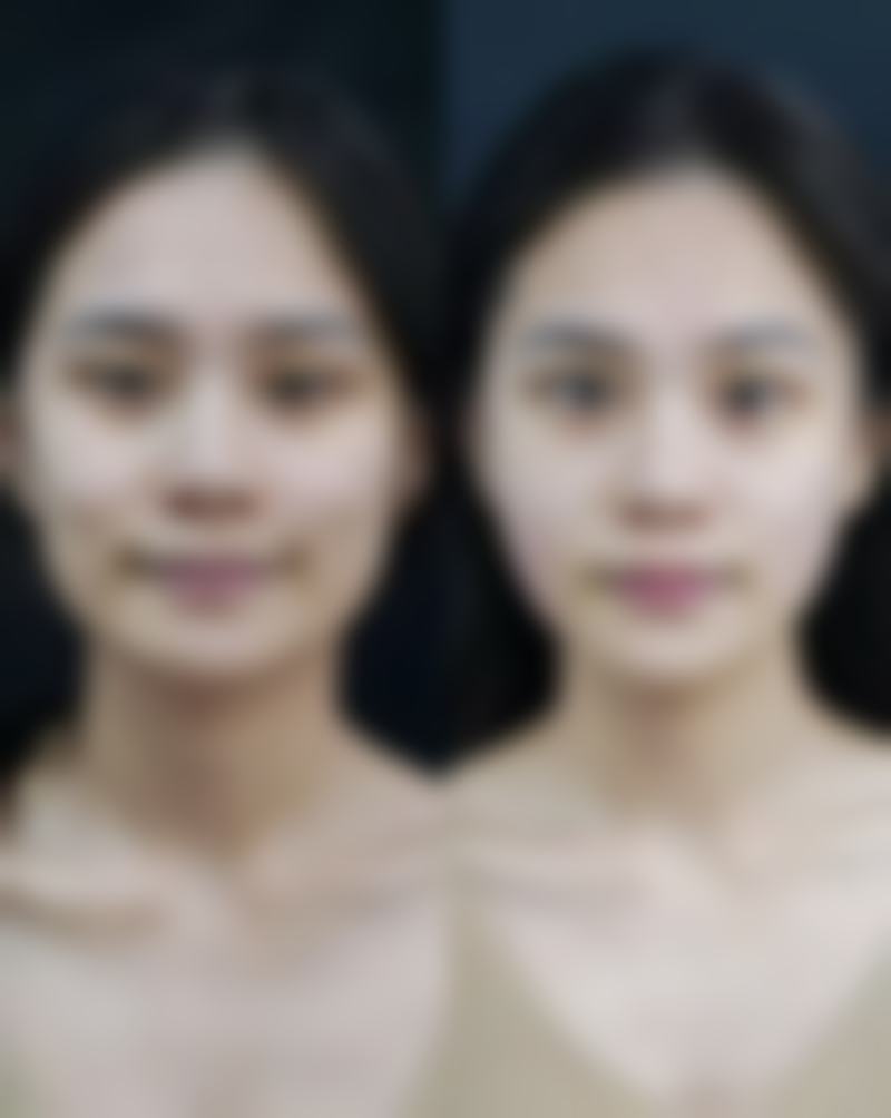 四、有什么方法可以去除眼袋之药物治疗