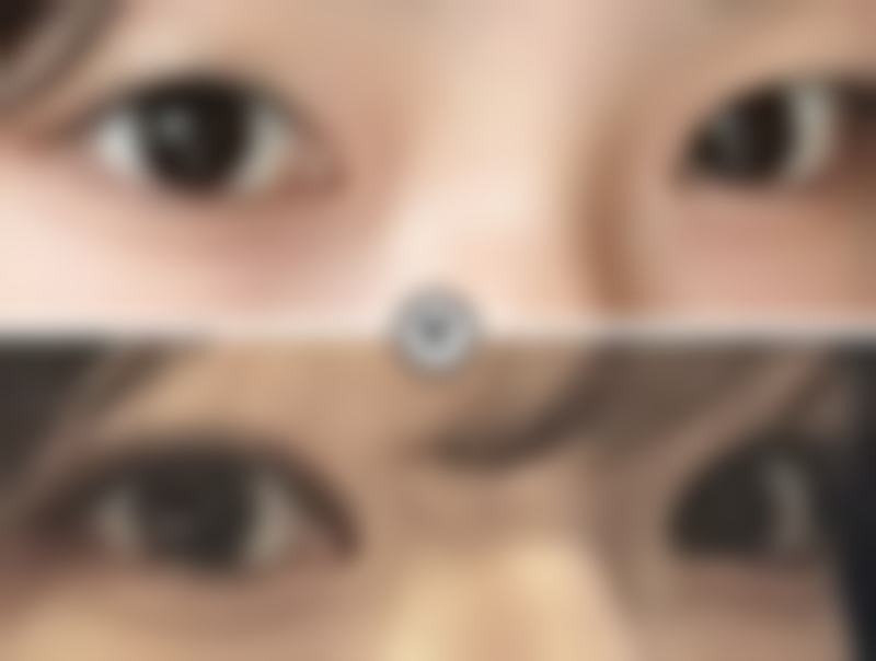 四、药水点痣疤痕增生的治疗方法