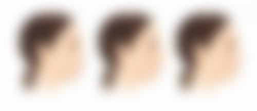 四、埋线双眼皮拆除后能否修复原样