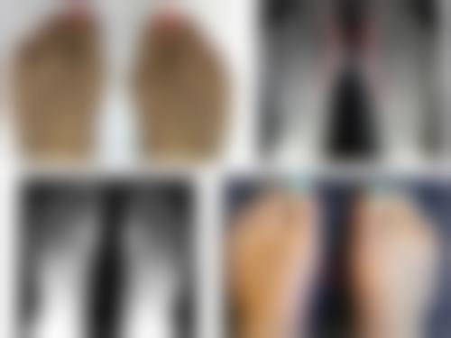 咬肌必须打瘦脸针吗？了解瘦脸针价格及效果 为你解答咬肌瘦脸疑惑