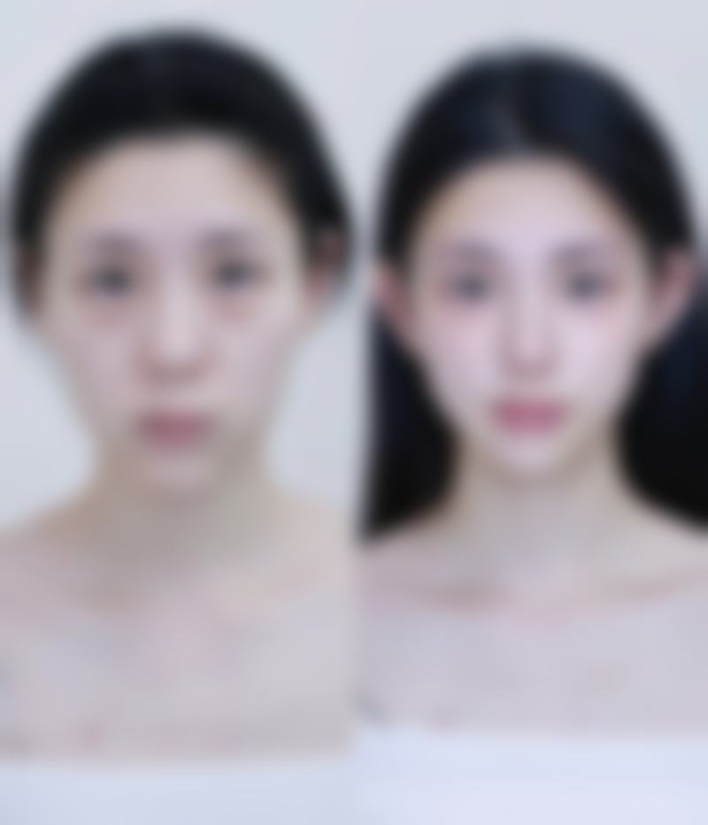 四、衰老型宽脸打瘦脸针有用吗