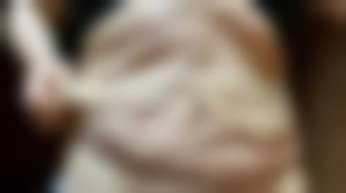 耳软骨隆鼻手术时间多久？受多种因素影响一般需 1 - 2 小时 