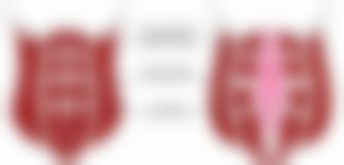 为什么隆鼻硅胶到一定时间要取出来呢？老化钙化影响美感或是主因 