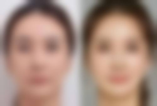 一、种植发常见副作用之毛囊炎