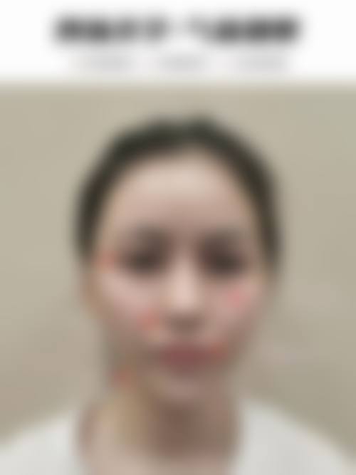 三、玉溪蕾特恩专精祛痘连锁诊疗项目有哪些？