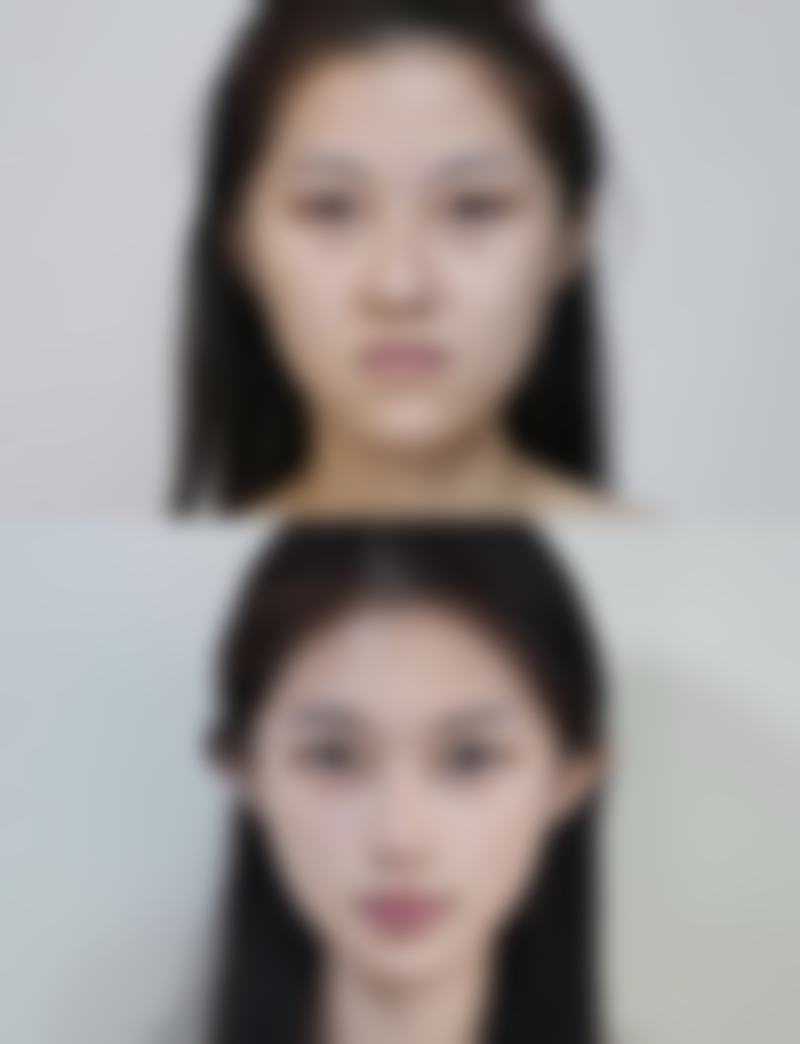 三、术后护理对留疤的影响