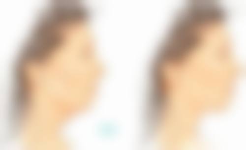 三、抽脂手术会有危险吗？哪些人不适合抽脂