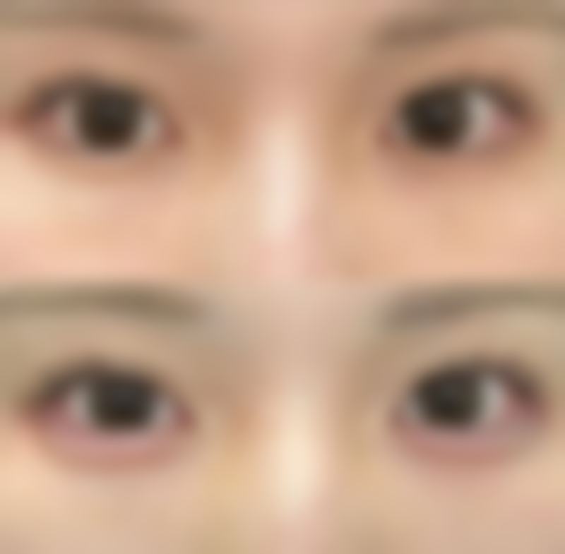 二、双眼皮割的大小不一的观察等待处理方式